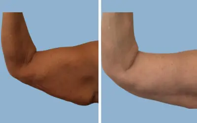 Before and After
